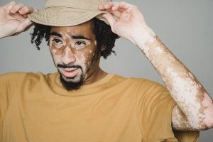 Young male in yellow T shirt with beard and vitiligo wearing hat and looking away on white background of studio